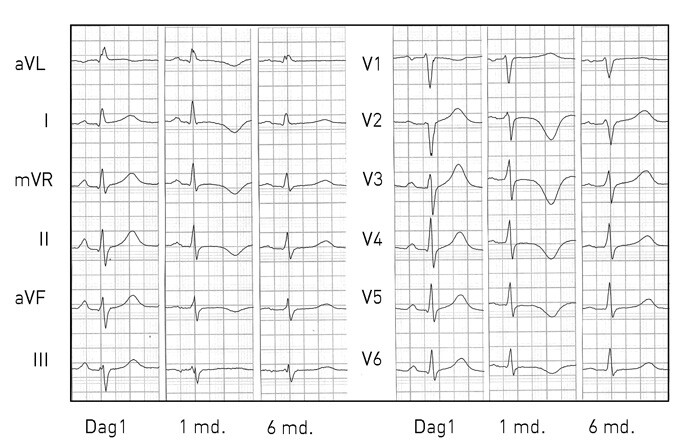 Figur 1  12-kanalers-EKG ved akuttinnleggelsen, etter én måned og etter seks måneder (tre måneder postoperativt)