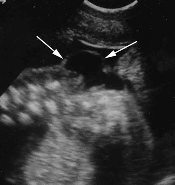 Bilete av spina bifida, lengdesnitt, fosteralder 18 veker. Pilene peikar p&aring; sj&oslash;lve myelomeningocelet. Foto Nasjonalt senter&hellip;