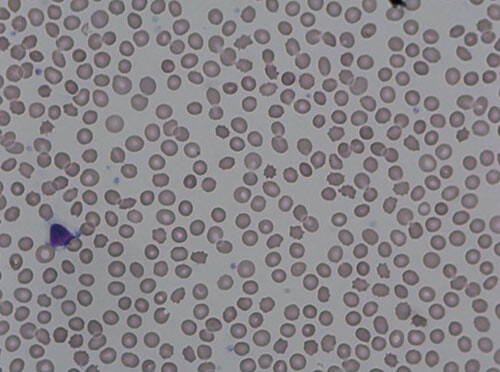 Figur 2  Akantocytter i perifert blod fra pasienten, karakteristisk for chorioakantocytose