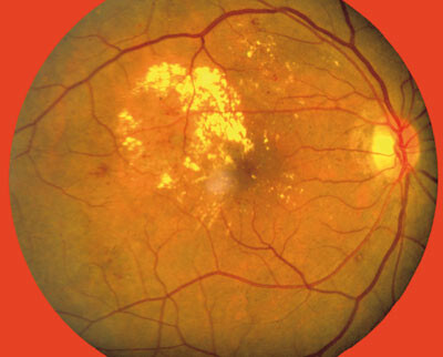 Retinopati er en av flere kjente komplikasjoner ved diabetes. Foto Photo Take/GvPress/NordicPhotos