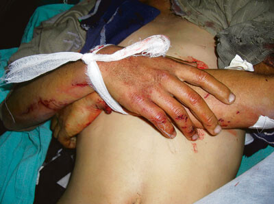 Død etter rakettangrep, 15 år. Alle foto NORWAC 2009