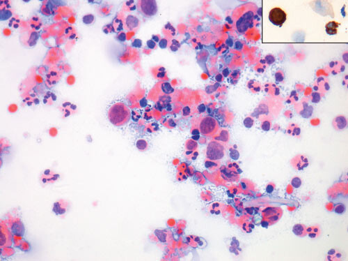 Figur 3  Atypiske celler i spinalvæsken, innfelt med pancytokeratinfarging
