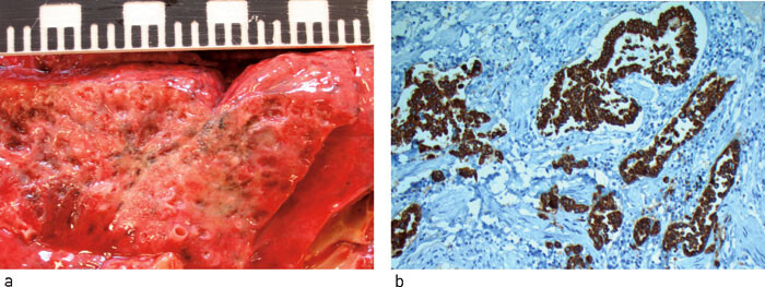 Figur 4  a) Lunge, makroskopisk. Arraktig fibrose i høyre lunge. b) Lunge, mikroskopisk, pancytokeratinfarging. Snittflate…