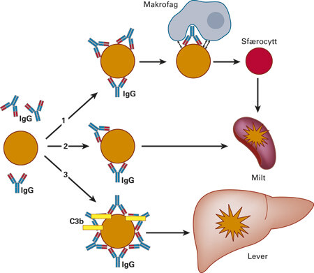 Figur 1 Autoimmun hemolytisk anemi av varmeantistofftype. Binding av antistoff til erytrocyttoverflaten kan initiere…