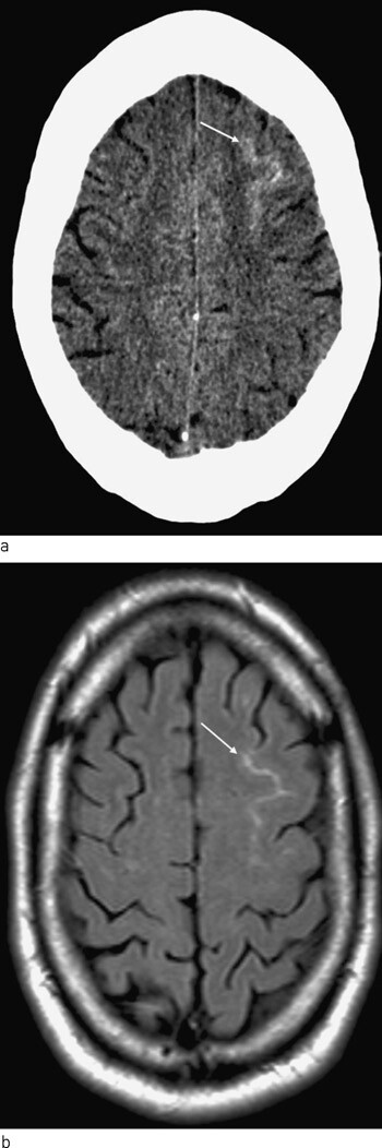Figur 1  a) CT- og b) MR-snitt (aksial FLAIR) som viser utbredelse av subaraknoidalt blod mellom gyrus frontalis superior og…