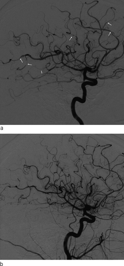 Figur 2  Intraarteriell cerebral angiografi med a) fremstilling av hjernearteriene på høyre side ved innkomst og b) ved…