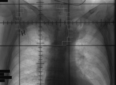 Figur 3  Strålefeltet innbefattet tumor med margin
