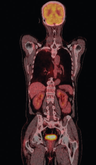 Figur 4  PET-CT viser lett økt opptak i tumor i høyre lunge, uten opptaksøkning i thoraxvegg. Det er svakt opptak i lungevev…
