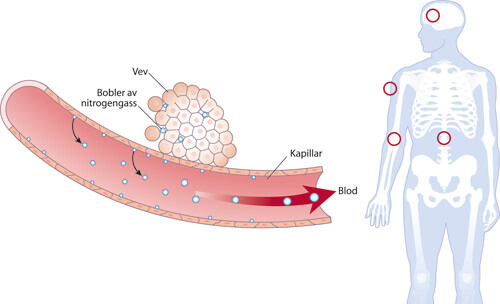 Figur 1  Etter avsluttet dykk kan det dannes gassbobler i vevene og i kapillarene. Symptomfrie venøse gassemboluser kan…