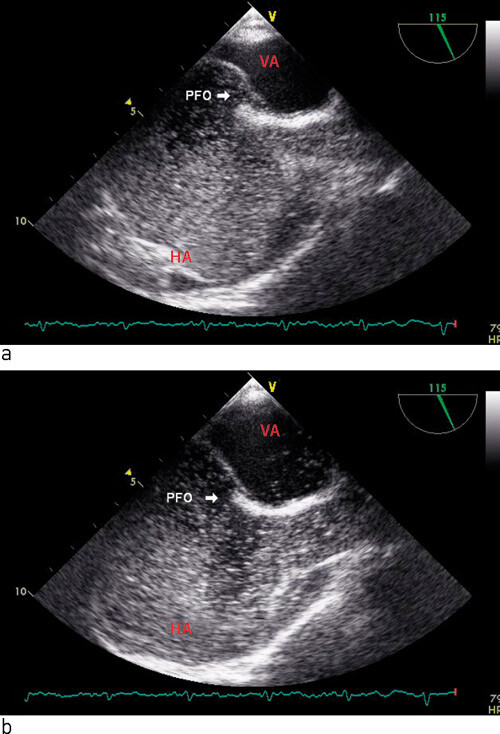 Figur 2  Transøsofageal ekkokardiografi med a) mikrobobler i høyre atrium (HA) og med b) overgang til venstre atrium (VA)…