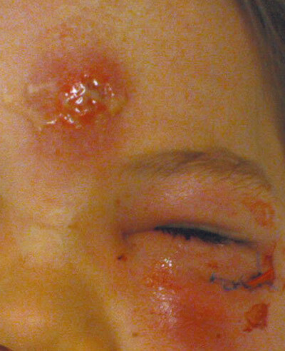 Figur 1  Pasientens lesjoner tidlig under sykehusoppholdet før mikrobiologisk diagnose og før målrettet behandling