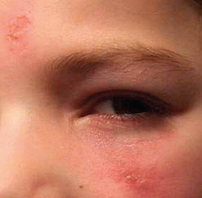 Figur 4  Pasientens lesjoner etter omtrent fem uker med målrettet antibiotikabehandling