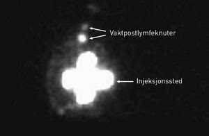 Figur 1  Lymfoscintigram av høyre bryst og aksille. Sentralt vises kraftig radioaktivitet ved injeksjonsstedet periareolært…