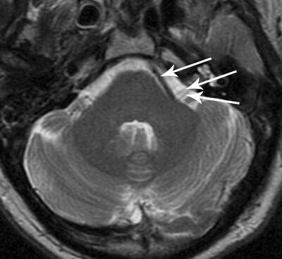 Den øverste pilen viser arterie, den midterste n. facialis og den nederste n. vestibulocochlearis