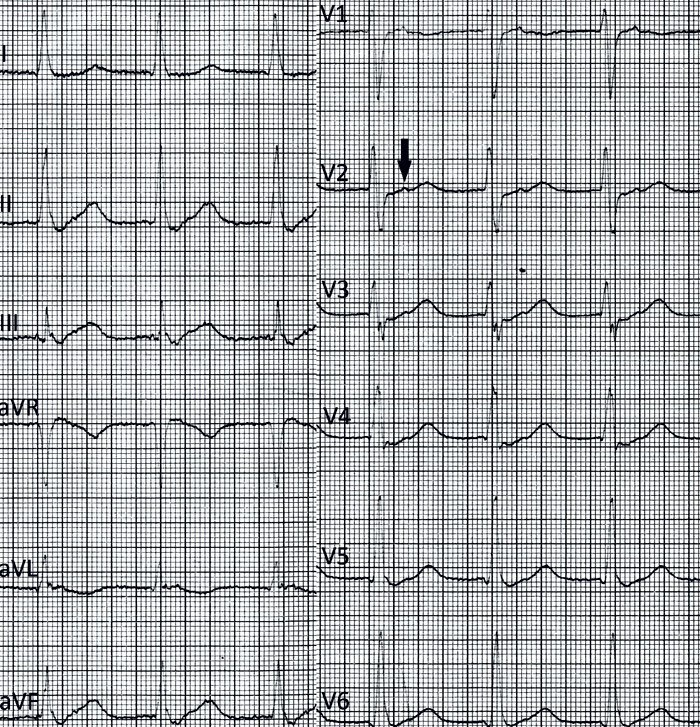 Figur 1  EKG tatt ca. et år før aktuelle innleggelse. Supraventrikulær takykardi med frekvens 127/min og med P-bølger ca…