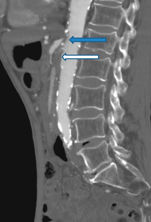 Figur 3  CT-angiografibilde som viser 8 mm lang okklusjon av truncus celiacus (blå pil) og 2,5 cm lang okklusjon av arteria…
