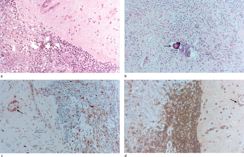 Figur 2  Biopsi av dura frontalt på venstre side. Histopatologisk undersøkelse viser fortykket dura med fibrose og…