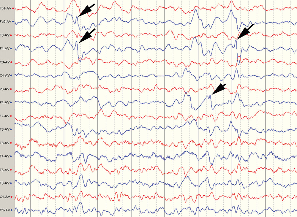 Figure 1  Two weeks after admission, the EEG shows slow activity, most pronounced in the right hemisphere (blue curve) and…