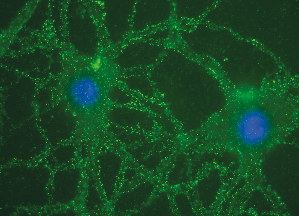 Figure 2  Two neurons in a cell culture from a rat hippocampus, immunostained with cerebrospinal fluid from a patient. The…