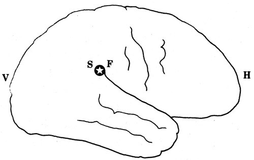 Fig 5  Fremmedlegeme p&aring; sprogsenteret. S: Sprogsenter. F: Fremmedlegeme. V: Venstre. H: H&oslash;yre