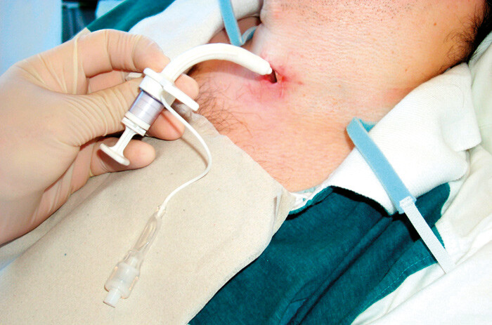 Nødtrakeotomi kan være et livbergende tiltak ved epiglotitt – her innleggelse av trakeostomitube via etablert trakeostoma…