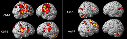 Bildet viser lokalisering i hjernen av fMRI-respons hos to friske barn (Cntrl-1, Cntrl-2) og to barn med autismediagnose …