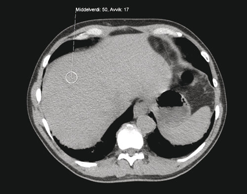 Figur 2  CT abdomen uten kontrastmiddel fra pasient uten patologiske forandringer