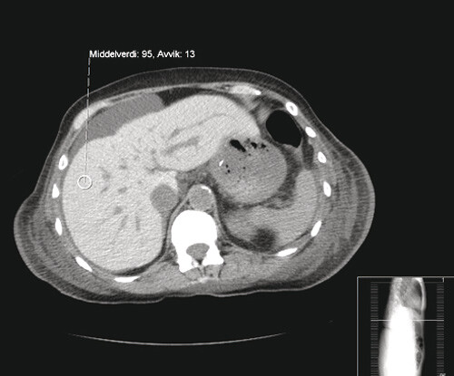 Figur 3  CT abdomen uten kontrastmiddel. Bildet viser høy attenuasjon i lever, som ved jernavleiring (dette til…