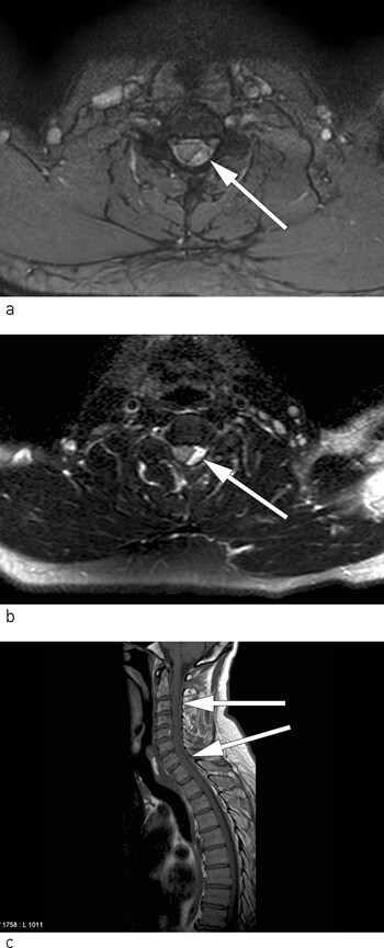 Figur 2  Epiduralt hematom med masseeffekt på ulike MR-sekvenser a) og b) aksiale snitt og c) sagittalt snitt, litt…