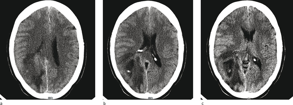 Figur 1  CT caput. H&oslash;yresidige parenkymforandringer parietooksipitalt med infiltrasjon av splenium corpus callosum, som kan&hellip;