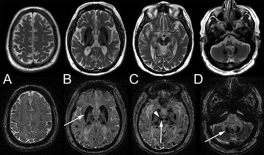 Figur 1  Cerebral MR av pasienten da han var i slutten av 50-årene. T2-vektede (øvre rad) og susceptibilitetsvektede (SWI,…