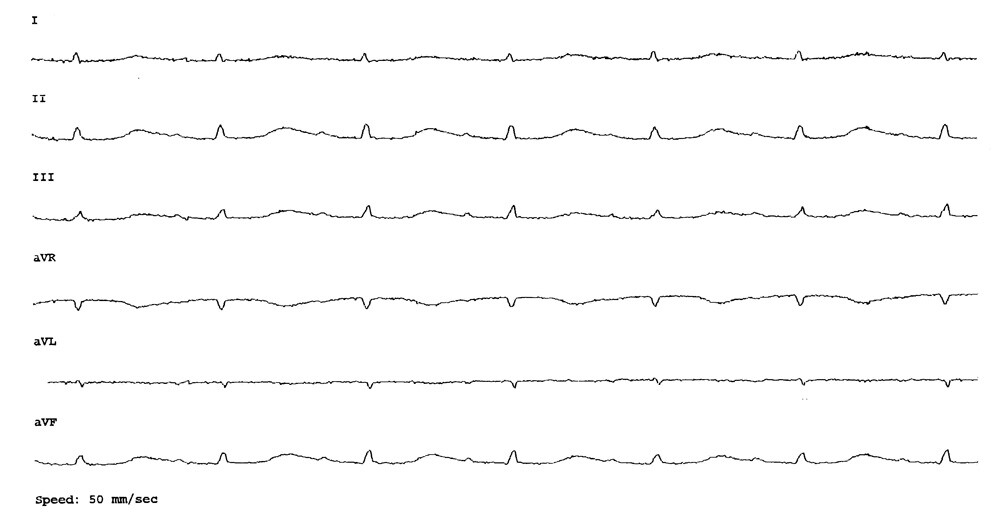 Figur 1 EKG viser sinusrytme med frekvens 79 per minutt, forlenget PQ-tid (0,23 s, referanse 0,12 – 0,20) og uspesifikke T…