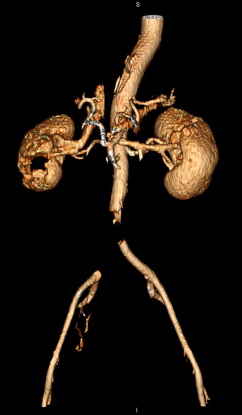 Figur 1  Tredimensjonal CT-angiografi viser manglende kontrastfylling i distale abdominalaorta og høyre a. iliaca communis,…