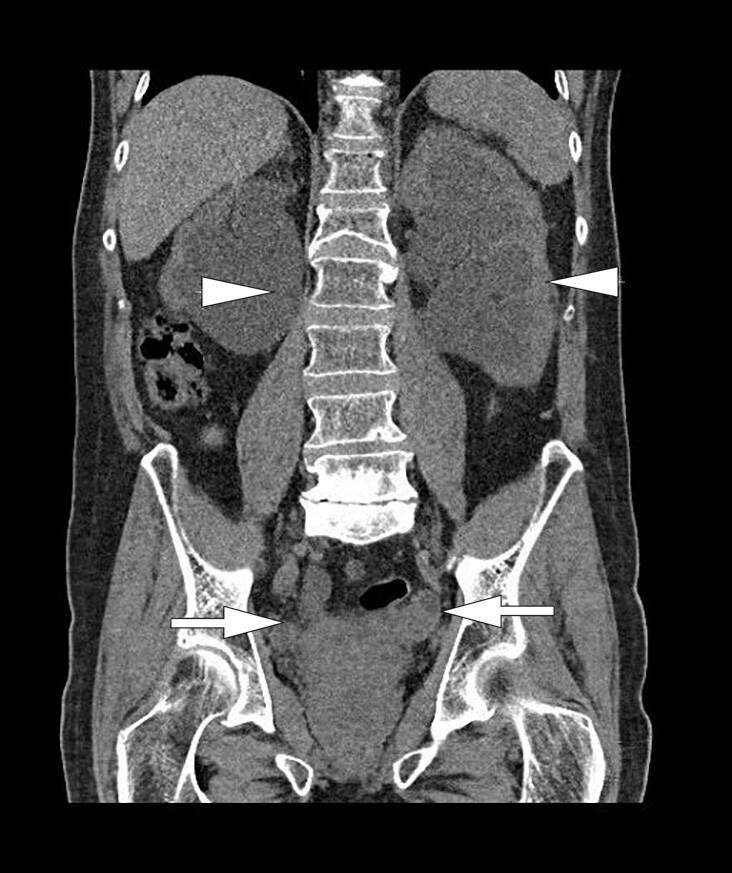 Figur 1  CT urinveier uten kontrast. Frontal projeksjon som viser massiv bilateral hydronefrose og bilateral hydroureter …