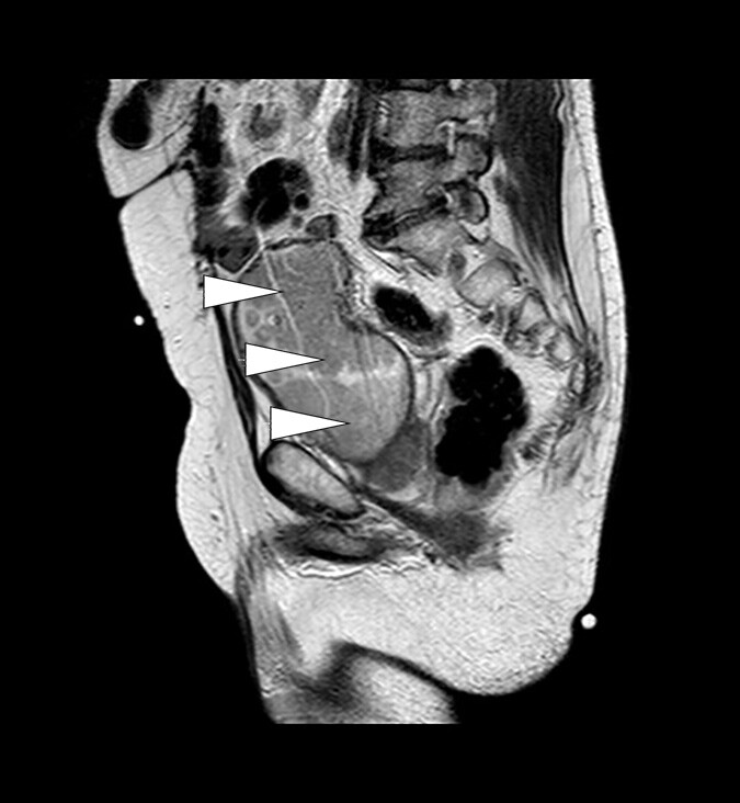 Figur 2  MR bekken (T2-vektet) i sagittal projeksjon med blæretumor (piler)