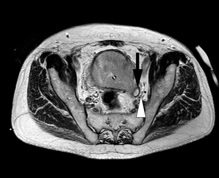 Figur 3  MR bekken (T2-vektet) i aksial projeksjon som viser blæretumor med gjennombrudd av blærens muscularis propria som…