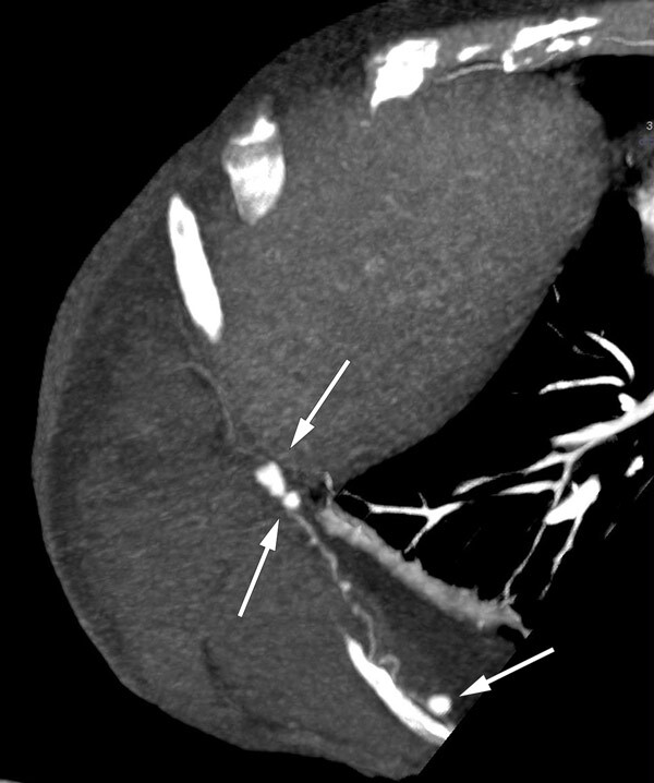 Figur 1  CT-fremstilling av 9. interkostalarterie på høyre side med flere aneurismer og blødning i thoraxveggen. Aneurismene…