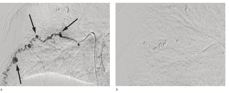 Figur 2  Endovaskulær intervensjon med coiling. 8. interkostalarterie er alt behandlet. De største aneurismene er markert…