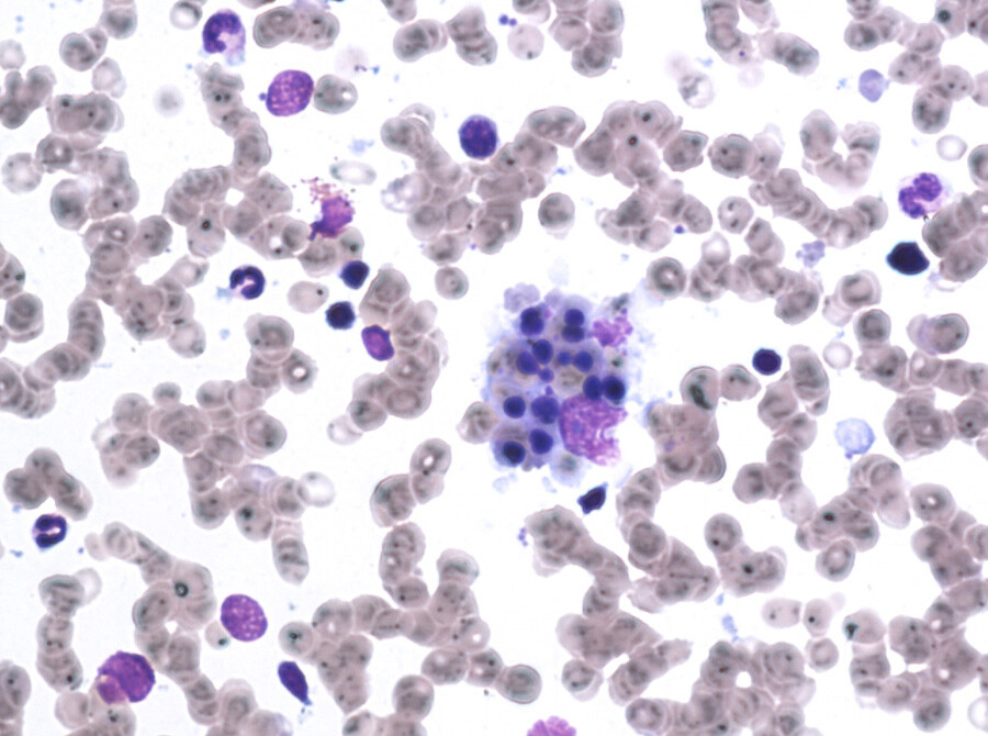 Figur 1  Bilde av pasientens beinmargsaspirat med enkelte stromale makrofager med fagocytterte erytrocytter. I cytoplasma…