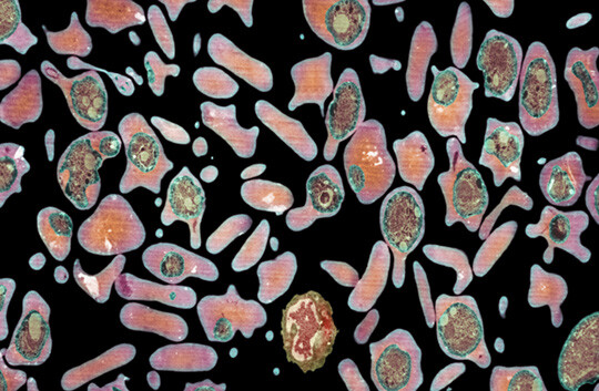 Transmisjonselektronmikrografi av røde blodceller infisert av malaria. Foto: Science Photo Library
