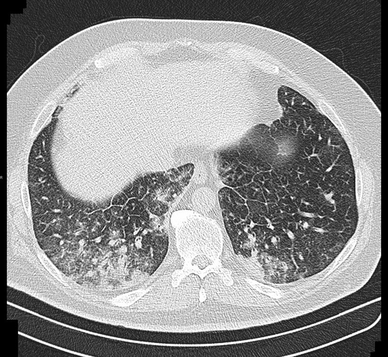 Figur 1  CT thorax tatt prehospitalt viser fortykkede intralobulære septa, diffuse mattglassfortetninger og nodulære…