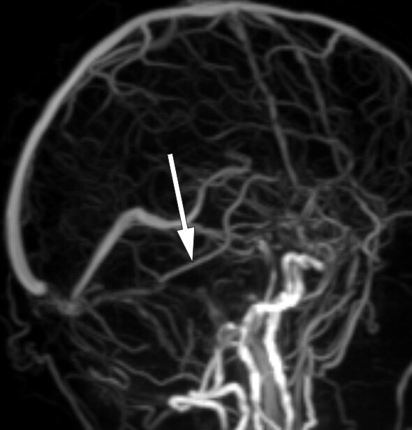Figur 3  Venøs MR-angiografi (TOF-sekvens) viser god fylling av kontralaterale vena Labbé (pil), mens ipsilaterale vene ikke…