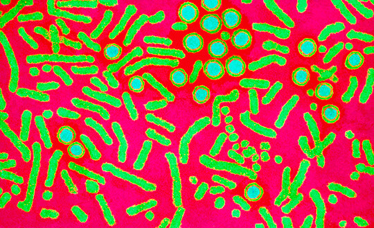Farget elektronisk mikrofotografi (coloured transmission electron micrograph, TEM) av hepatitt B-viruset og dets antigen. De…