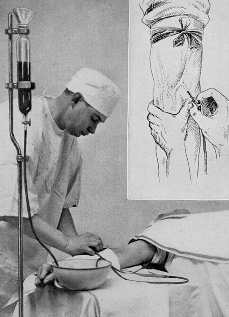 Slik skulle Salvarsan injiseres, ifølge en illustrasjon fra 1915. Fra boken Applied Immunology. The Practical Application of…