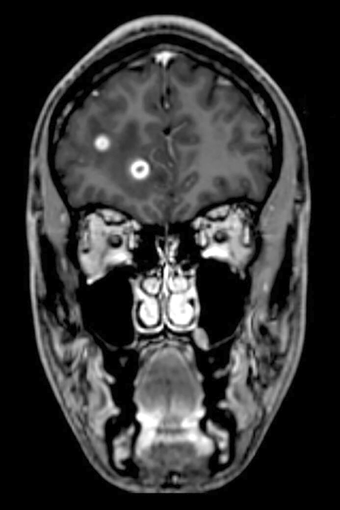 Figur 2 T1-vektet volumetrisk magnetisk resonanstomografi av hjerne og medulla, tatt med kontrastmiddel. Bildet viser…