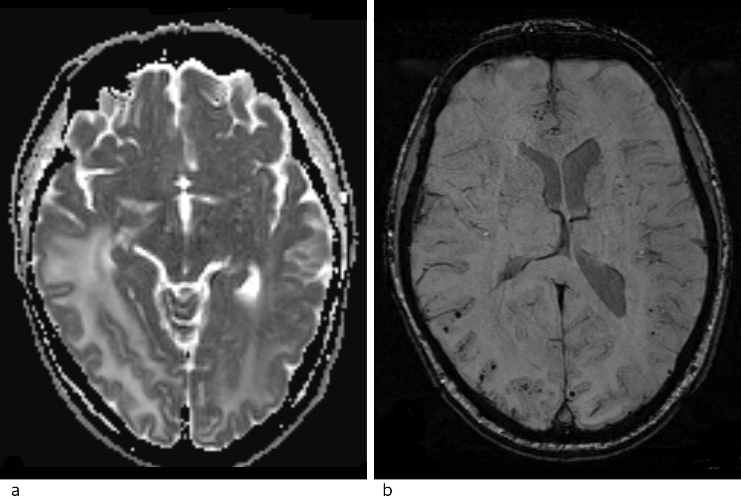 Figur 2 MR caput. a) ADC-kart fra diffusjon viser høye verdier forenlig med vasogent ødem. b) Suceptibilitetsvektede…