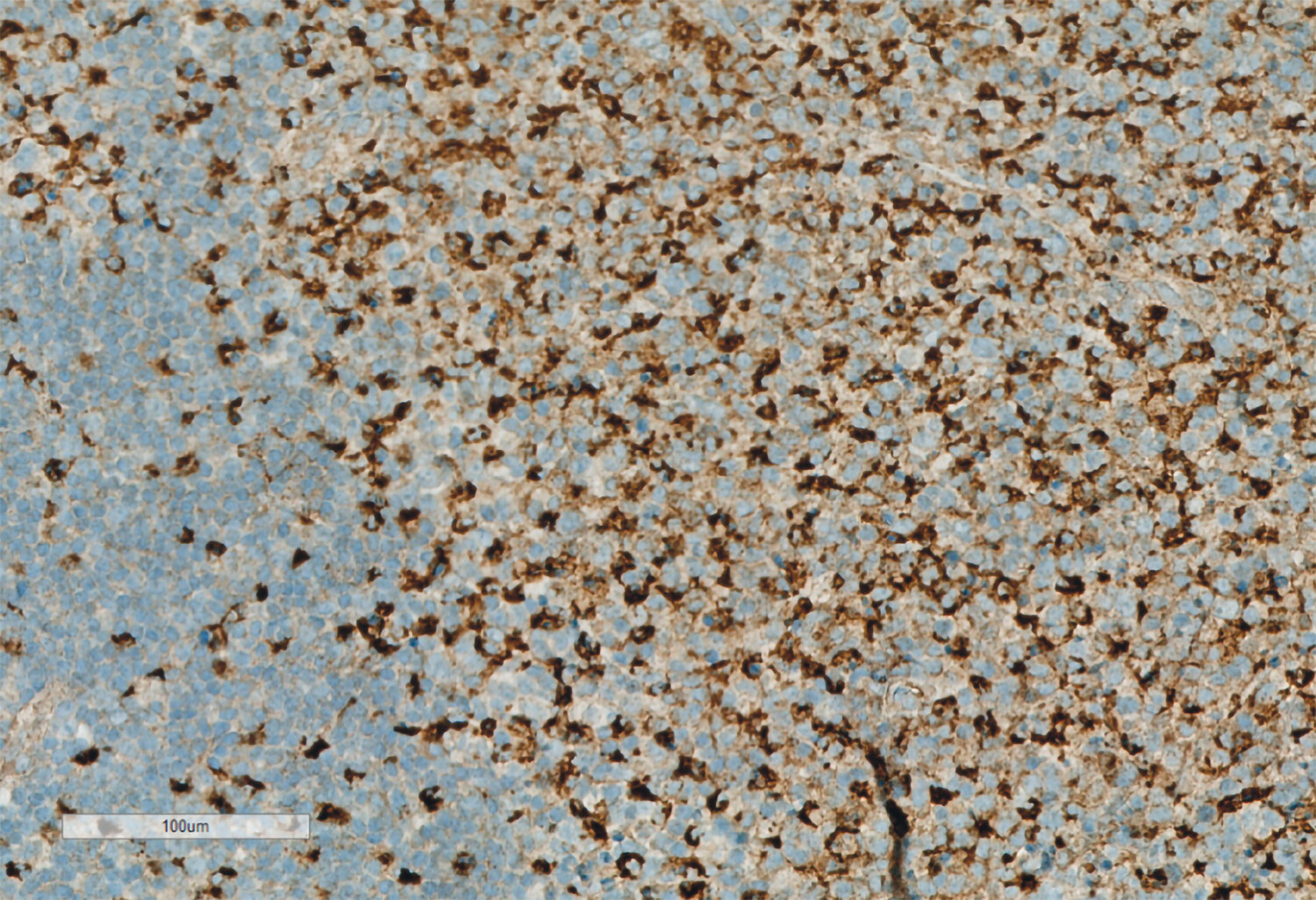 Figur 2 Detalj av CD68-immunfarging. Man ser tydelig et økt antall histiocytære celler.