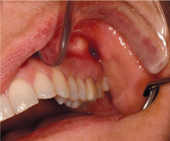 Figur 1 Periapikal abscess fra molar i overkjeven p&aring; venstre side.