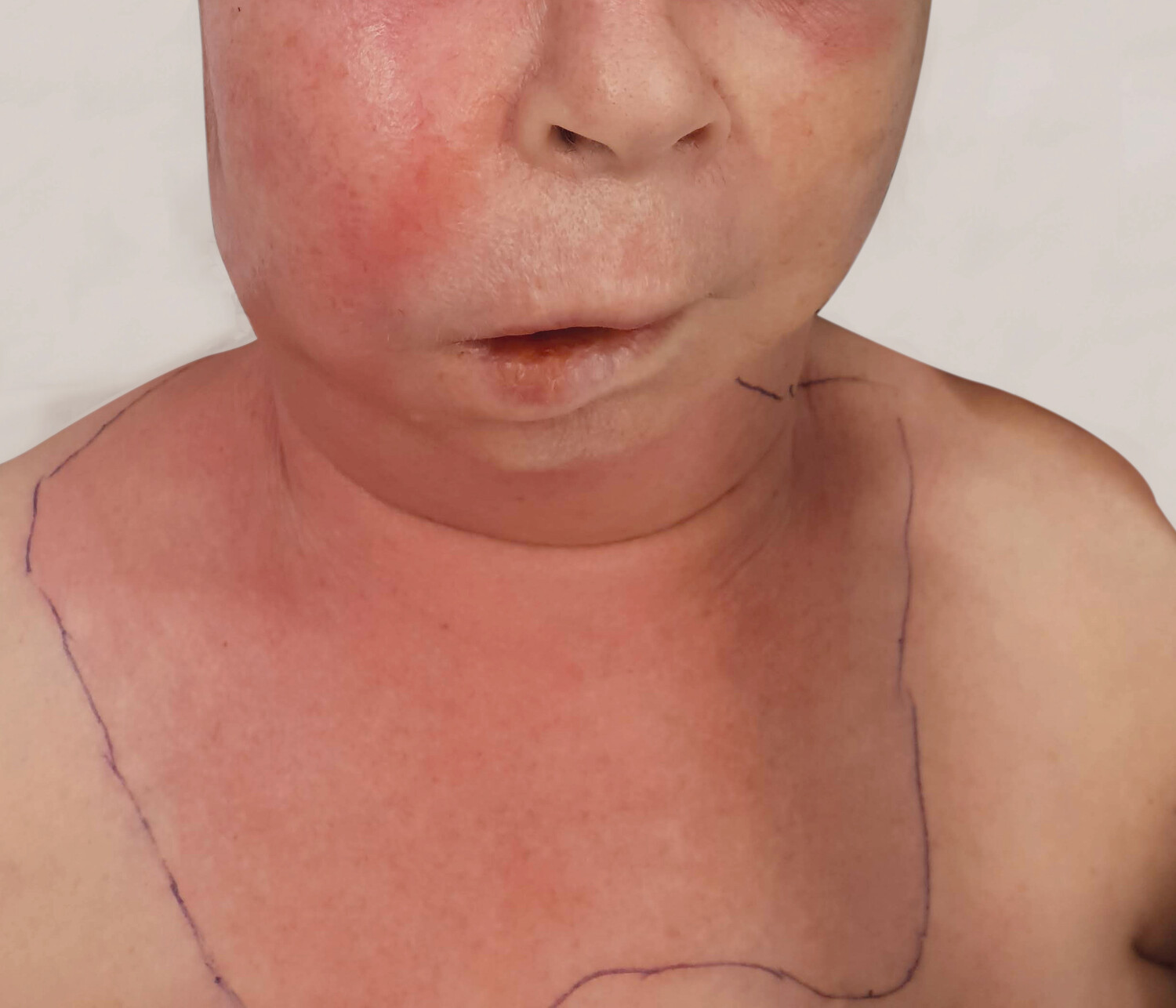 Figur 3 Nekrotiserende bl&oslash;tvevsinfeksjon utg&aring;ende fra periapikal abscess p&aring; molar i overkjeven p&aring; h&oslash;yre side.
