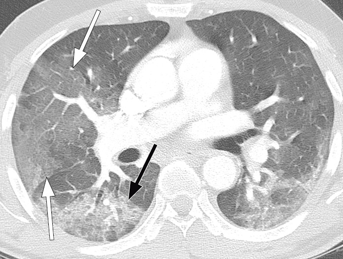 Figure 5 Patient with COVID-19. Chest CT seven days after symptom onset shows extensive bilateral ground-glass opacities &hellip;